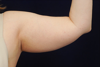 Liposuction
