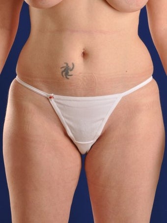 Vaser Hi Def Liposuction of abdomen, thighs, flanks and back with fat injections to buttocks