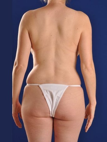 Vaser Hi Def Liposuction of abdomen, thighs, flanks and back with fat injections to buttocks
