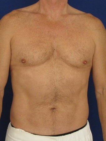 Vaser Hi Def Liposuction of chest, abdomen, back and flanks