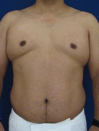 Vaser Hi-Def Liposuction of abdomen, chest, back and flanks