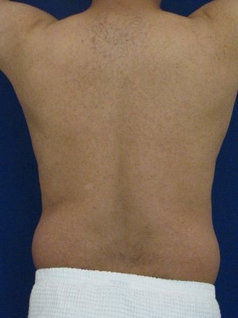 Vaser Hi Def Liposuction of chest, abdomen, back and flanks