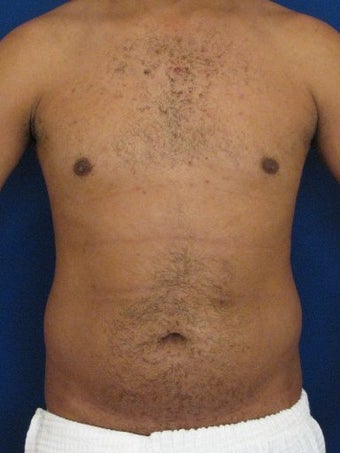 Vaser Hi Def Liposuction of the abdomen, chest, back, and flanks with fat injections to the pectoralis region