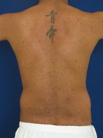 Vaser Hi Def Liposuction of the abdomen, chest, back, and flanks with fat injections to the pectoralis region