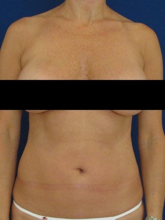Vaser Hi Def Liposuction of chest, abdomen, back and flanks