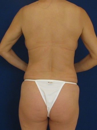 Vaser Hi-Def Liposuction of abdomen, chest, back and flanks