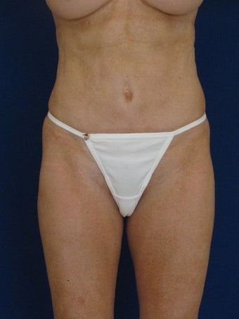 vaser Hi Def Liposuction of chest, abdomen, back and flanks