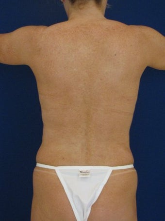 Vaser Hi Def Liposuction of chest, abdomen, back and flanks