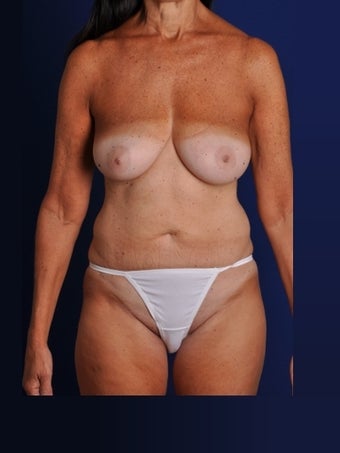 Vaser Hi Def Liposuction of abdomen, thighs, flanks and back with fat injections to buttocks