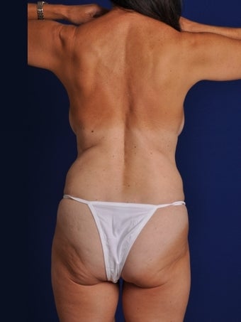 Vaser Hi Def Liposuction of abdomen, thighs, flanks and back with fat injections to buttocks