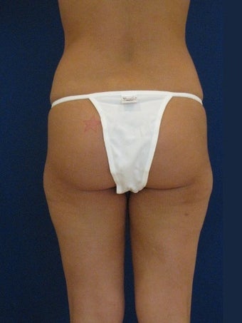 Vaser Hi-Def Liposuction of the back, flanks, medial and lateral thighs