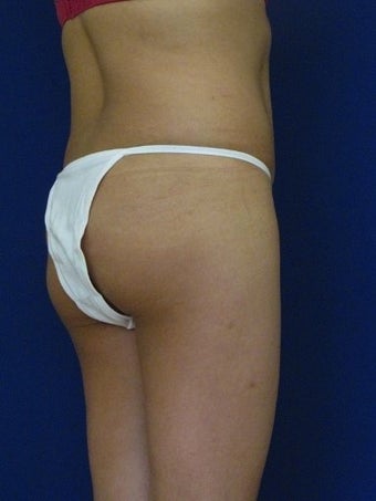 Vaser Hi Def Liposuction of the back and flanks with fat injections to the buttocks