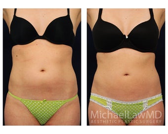 Liposuction