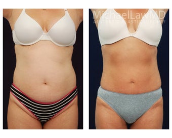 Liposuction