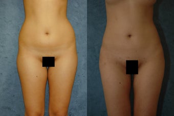 VASER Liposuction