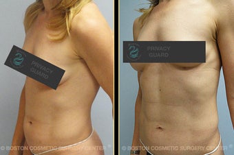 Vaser Liposuction