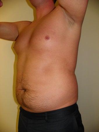 VASER Liposuction (HiDef)