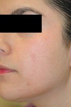 Facial Spider Vein Removal 