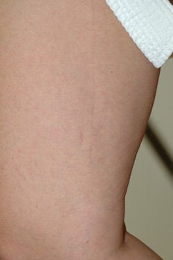 Leg vein removal 