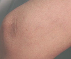 Leg vein removal with laser treatments