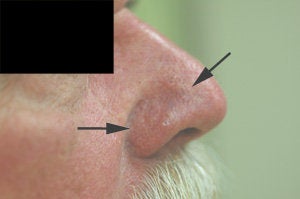 Vein removal on the nose with laser treatments