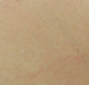 Spider vein removal with laser treatments