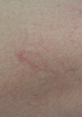 Spider Vein Removal for the Legs