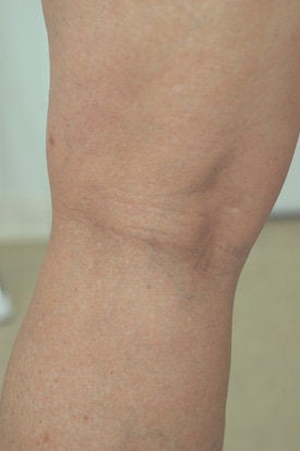 Laser Spider Vein Removal