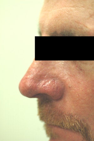 Nose spider vein removal