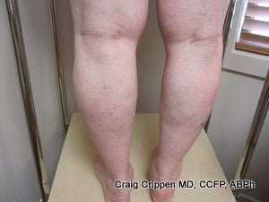 EVLT of Small Saphenous Vein
