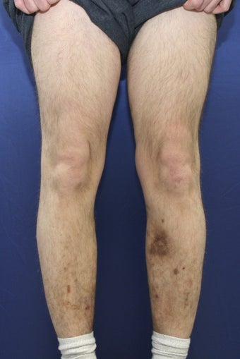 vnus ablation