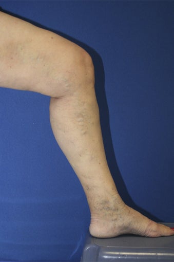 vnus ablation