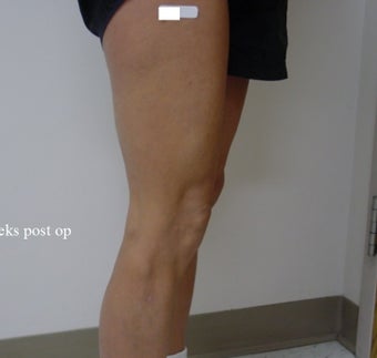 vnus ablation