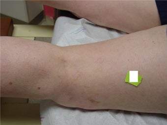 Sclerotherapy