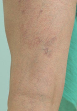 Laser Treatments for Spider Veins 