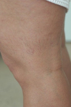 Leg vein removal 