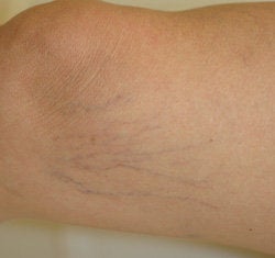 Leg vein removal with laser treatments