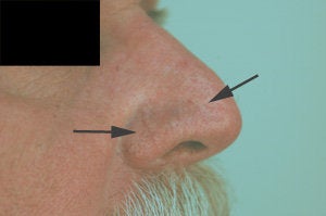 Vein removal on the nose with laser treatments