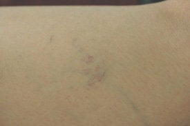 Spider vein removal with laser treatments