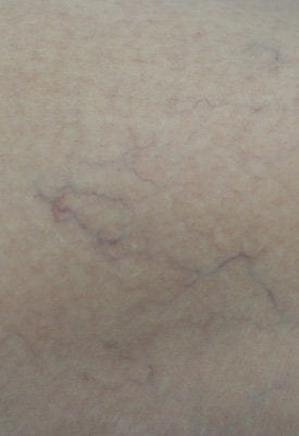 Spider Vein Removal for the Legs