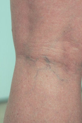 Laser Spider Vein Removal