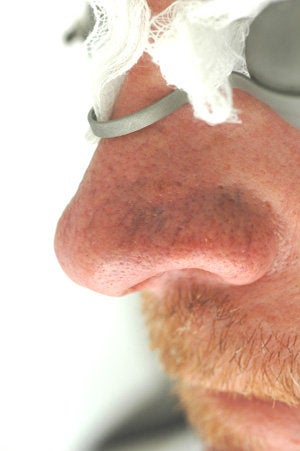 Nose spider vein removal
