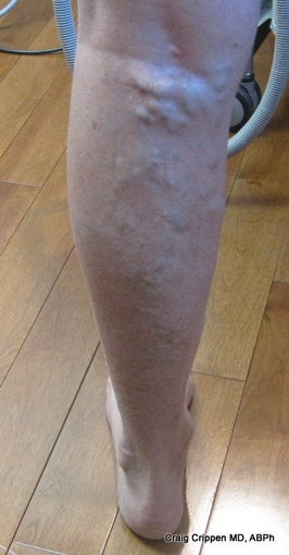 EVLT of Small Saphenous Vein