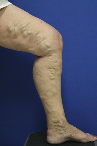 vnus ablation