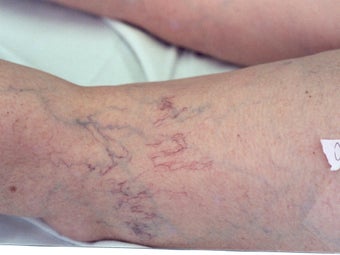 Sclerotherapy