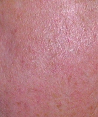 Laser vein treatment