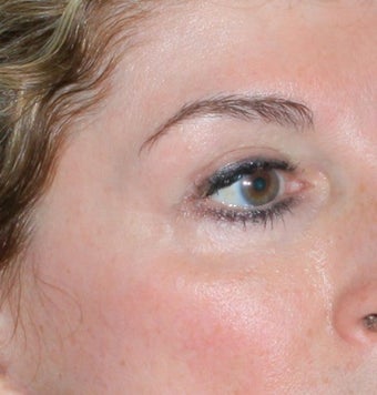 Laser vein removal