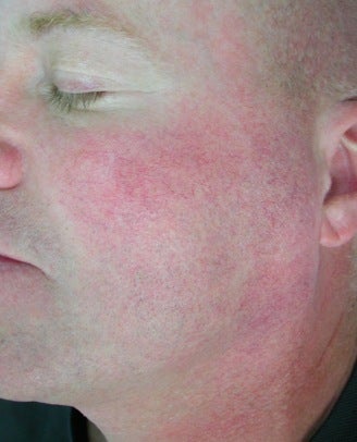 Facial Vein Treatment