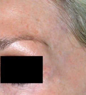 Laser facial vein treatment
