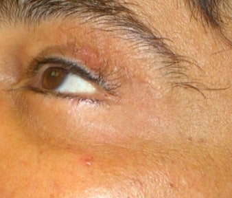 Laser Vein Treatment